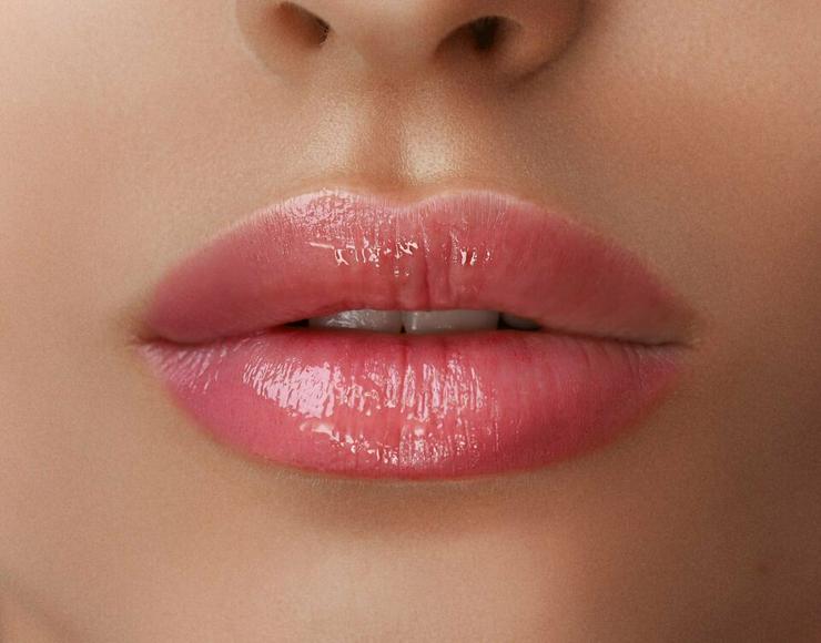 Bild 1: Mehr Lippenvolumen mit 1 ml Hyaluron von Revolax