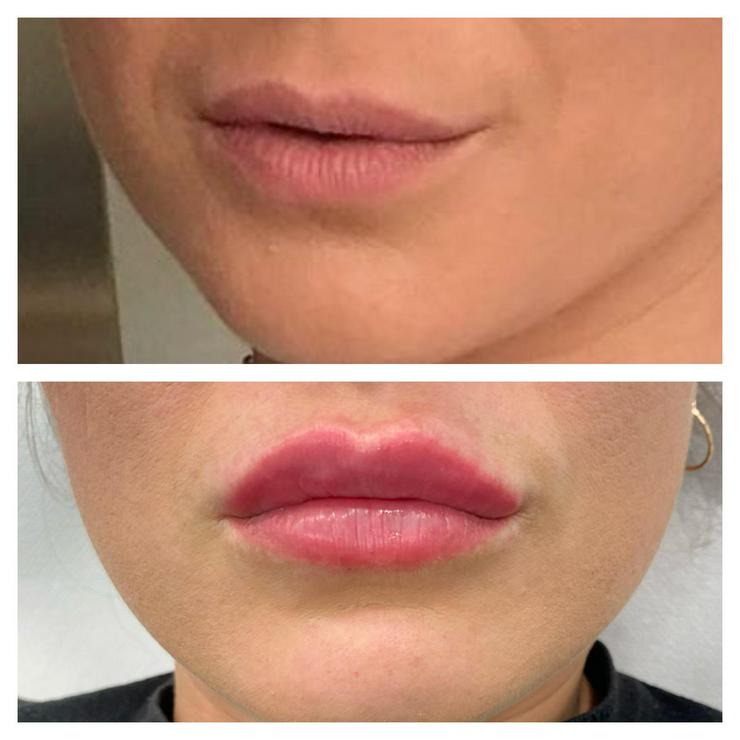 Mehr Lippenvolumen mit 1 ml Hyaluron von Revolax - Schönheit & Wohlbefinden - Bild 2
