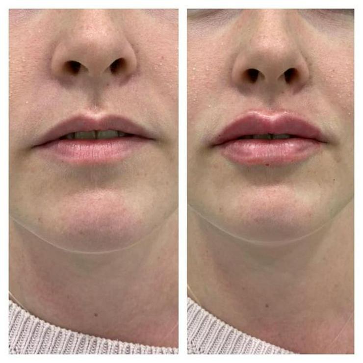 Mehr Lippenvolumen mit 1 ml Hyaluron von Revolax - Schönheit & Wohlbefinden - Bild 3
