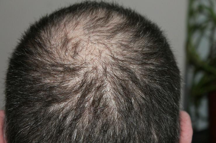 Haarausfall, Haarverlust, Haarkranz entgegentreten mit MesoHair